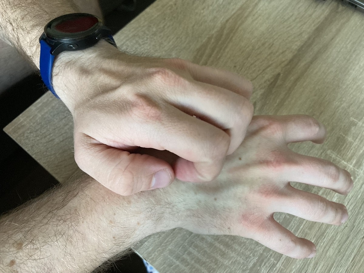 9 příčin svědění prstů na rukou a jak si pomoci